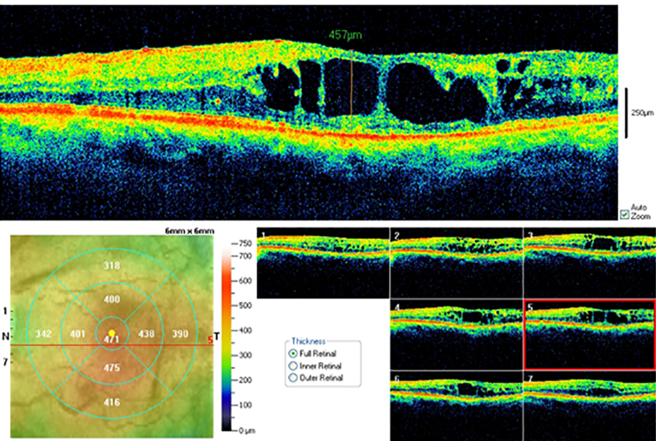 edema-macular-02