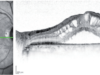 edema macular oct