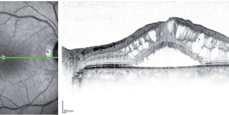 edema macular oct